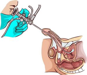 Ureteroskopie-Verfahren